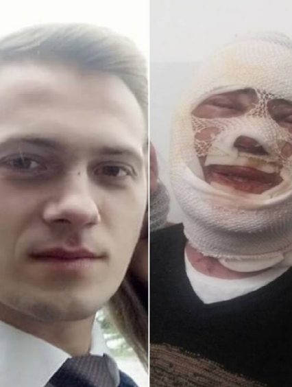 Постраждалий від «хімічного» нападу ужгородець йде на поправку (ВІДЕО)