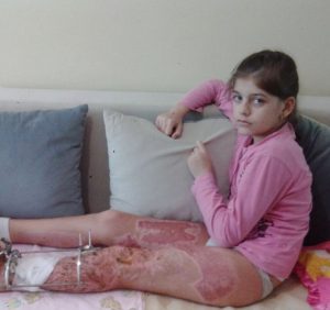 Відбудеться чергове засідання суду у справі про каліцтво ужгородськими комунальниками Анітки Білей