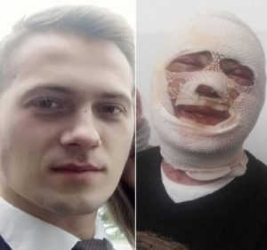 В Ужгороді поліція розкрила напад на молодого чоловіка, якого облили кислотою